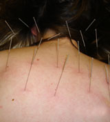 bone spurs acupuncture houston,