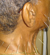 migraine acupuncture houston