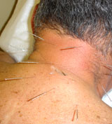 neck pain acupuncture houston