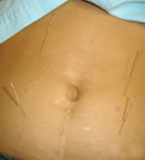 weight loss acupuncture houston